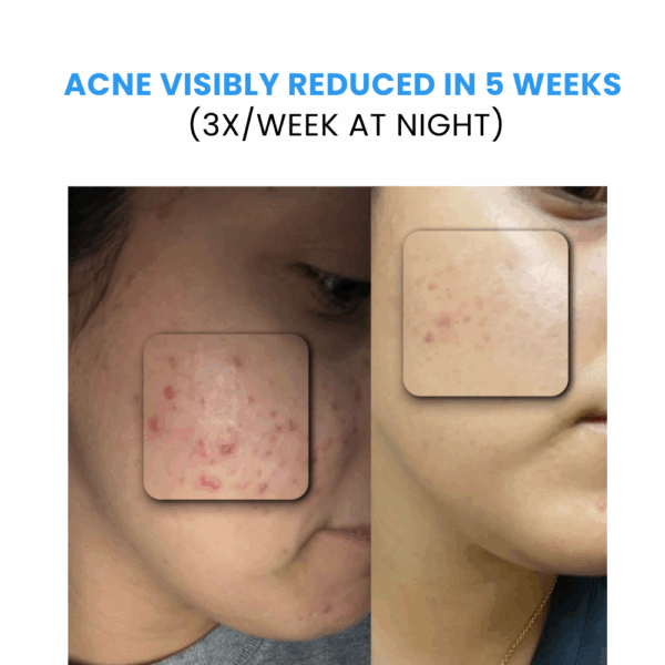 Acne Visibility reduce in 5 weeks of using vora skin renewe