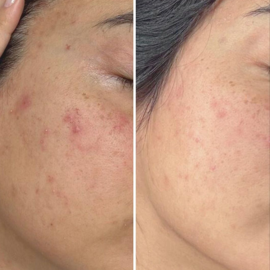 Salicylic & Mandelic Acid Cleanser - Image 4