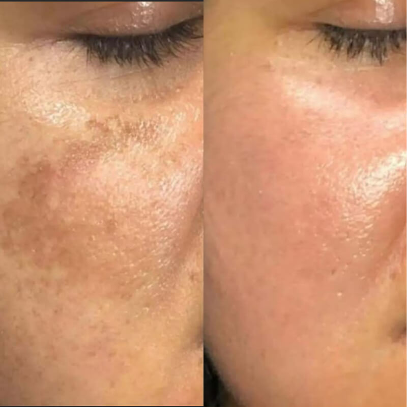 Niacéa-10+-Brightening-Moisturizer-result-before-after-four