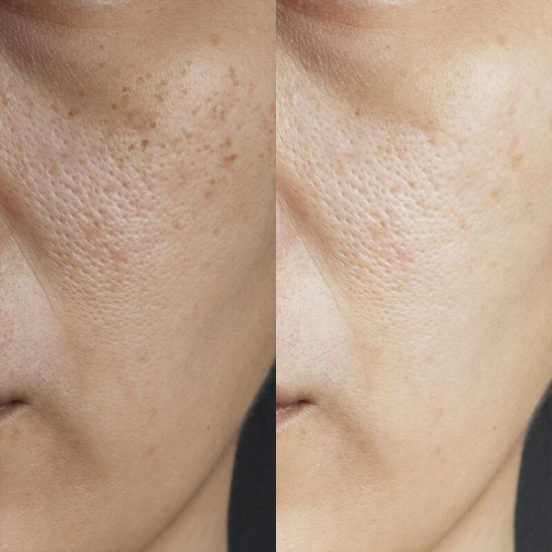 Niacéa-10+-Brightening-Moisturizer-result-before-after-two