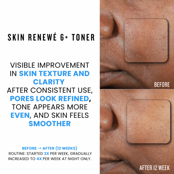 Results after 12 weeks of consistent use of Skin Renewé Toner