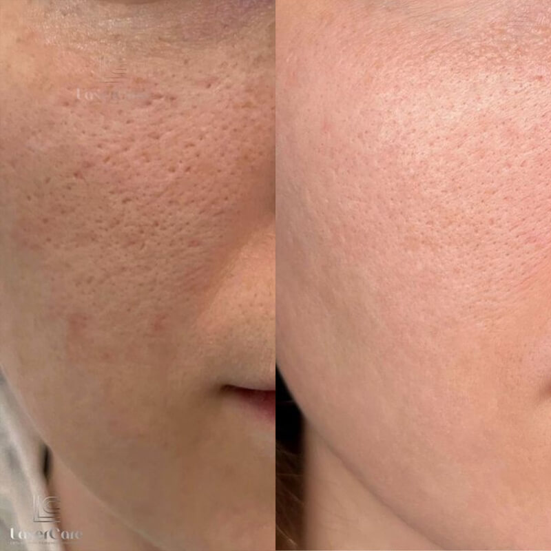 before-after-toner-2